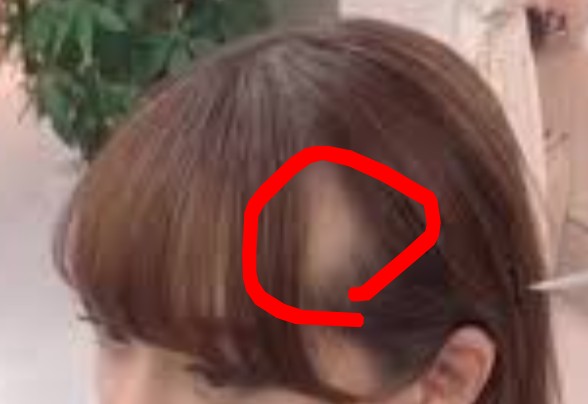 M字の悩みって、このスカッとした感じ